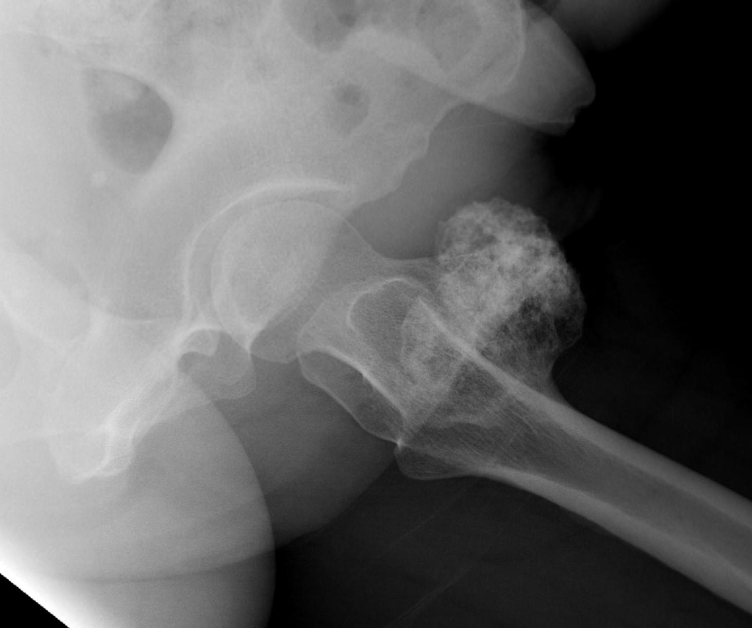 Proximal Femur Bony Tumour0002